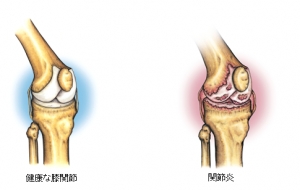 健康な膝関節（イラスト：左）　関節炎（イラスト：右）