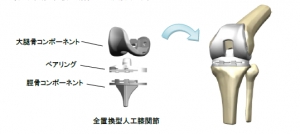 全置換型人工関節（TKA）