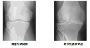 健康な膝関節（写真：左）　変形性膝関節症（写真：右）